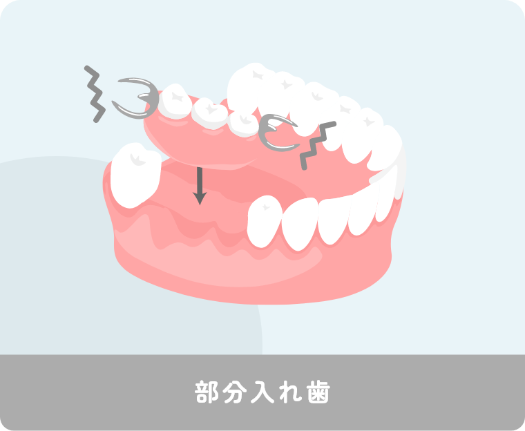 部分入れ歯