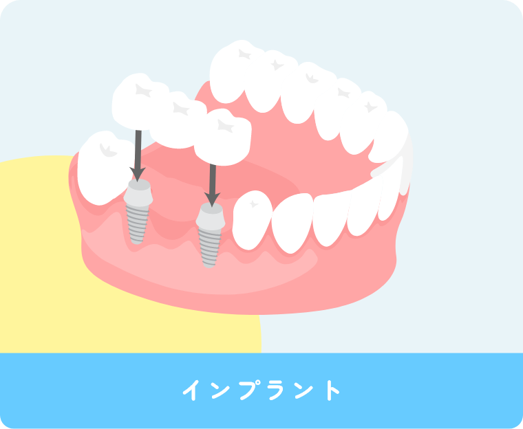 インプラント